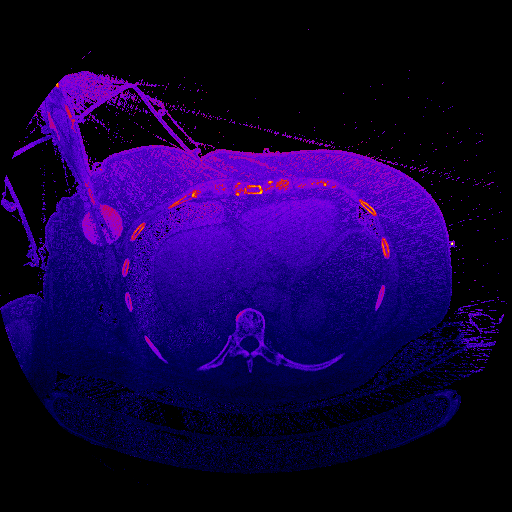ThoraxDosimetry